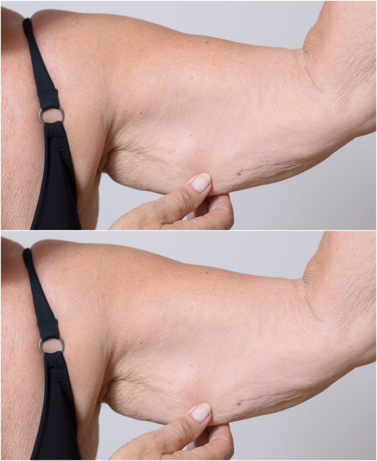 Слабость мышц у пожилых людей – это саркопения. Как можно предотвратить ее трагические последствия