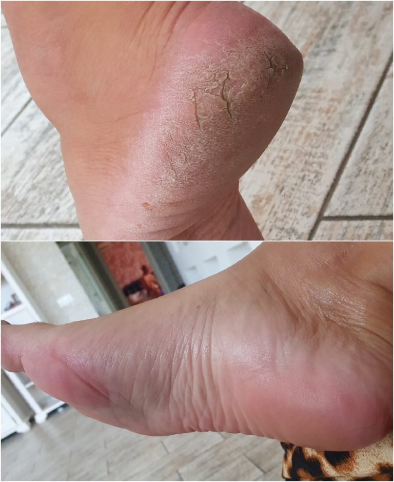 Пятки как у младенца за 3-5 минут. Показываю ход работ и свой результат